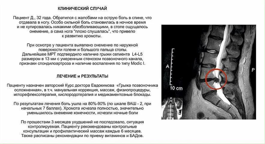 Сильные боли грыжа позвоночника. Грыжа Шморля поясничного отдела на мрт. Грыжа Шморля крестцового отдела. Гимнастика при стенозе позвоночного канала поясничного отдела. Упражнения при стенозе поясничного отдела позвоночника.