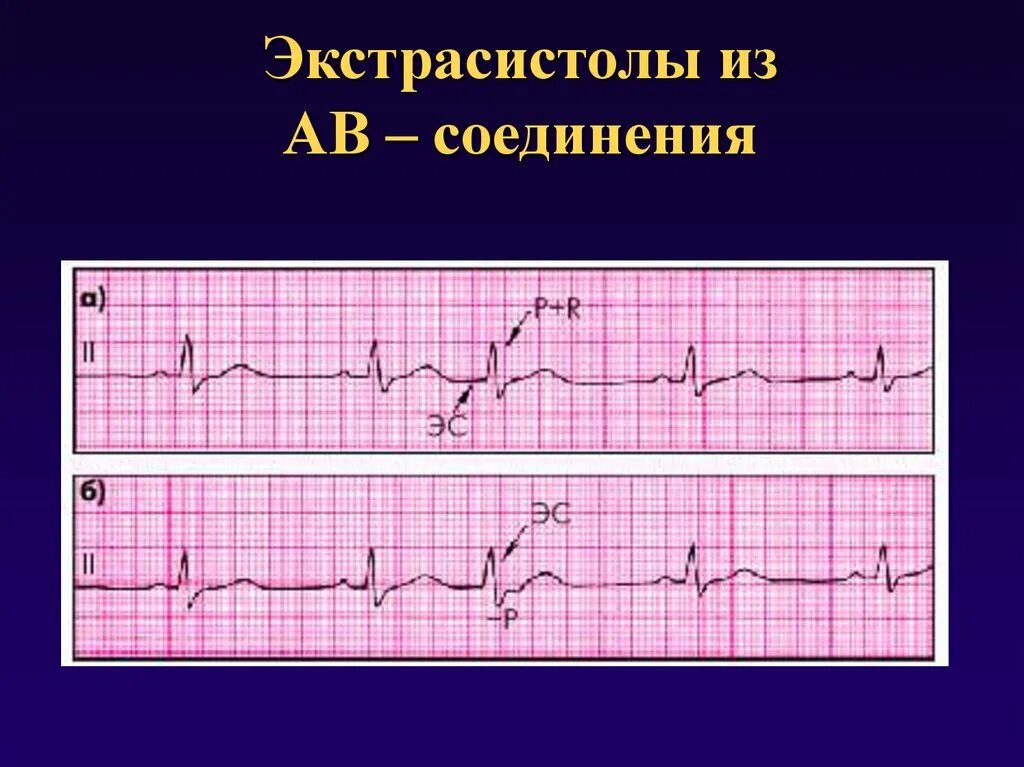 Экстрасистолы из ав соединения