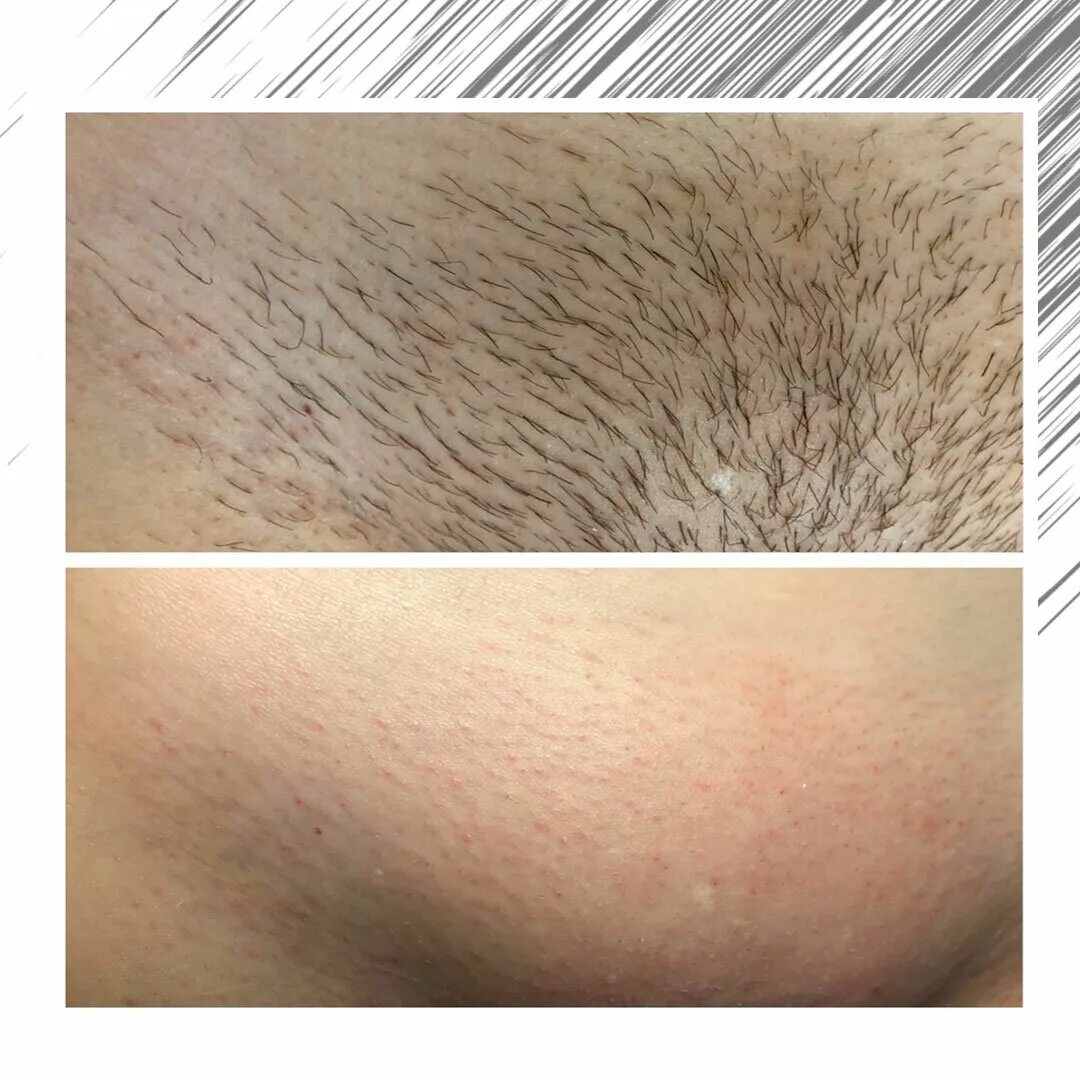 депиляция глубокое бикини. шугаринг бикини. эпиляция бикини глубокое. первый шугаринг бикини. эпиляция бикини до и после.