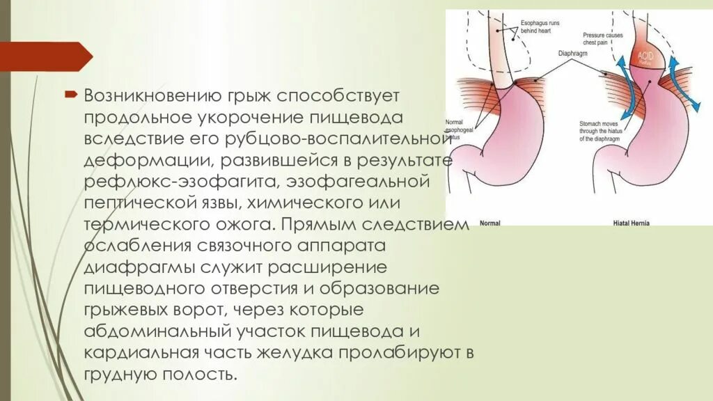 Диафрагмальный пищевода