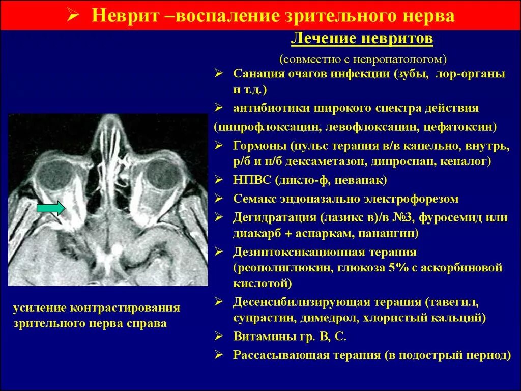 Почему воспаляется нерв. Ретробульбарном неврите зрительного нерва. Воспален е зрительнного нерраа. Неврит зрительного нерва лекарства. Воспаление зрительного нерва.