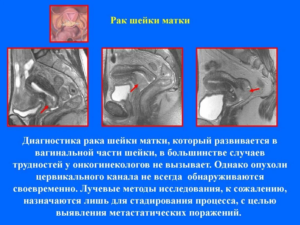 Опухоли шейки матки на мрт. Мрт эндометрия