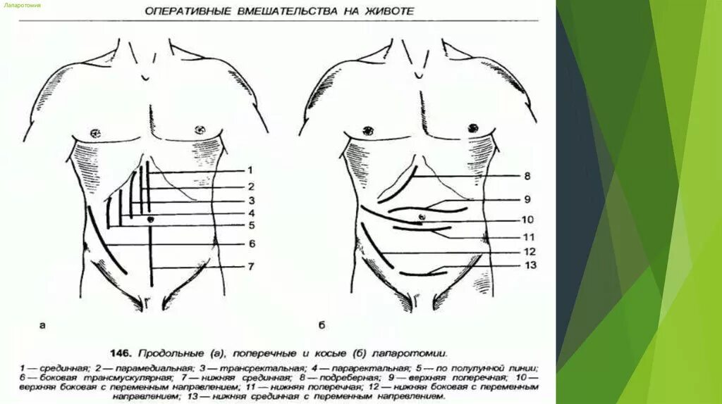 Какое лапаротомия. 1. Верхне-срединная лапаротомия. Лапаротомия топографическая анатомия. Нижнесрединная лапаротомия. Верхнесрединная лапаротомия показания.