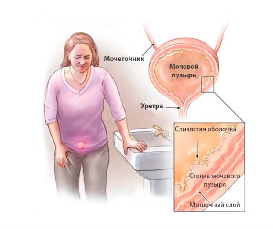 болит когда писаю женщина. цистит у женщин симптомы. болит когда писаю женщина. больно ходить в туалет по маленькому причины. цистит причины возникновения.