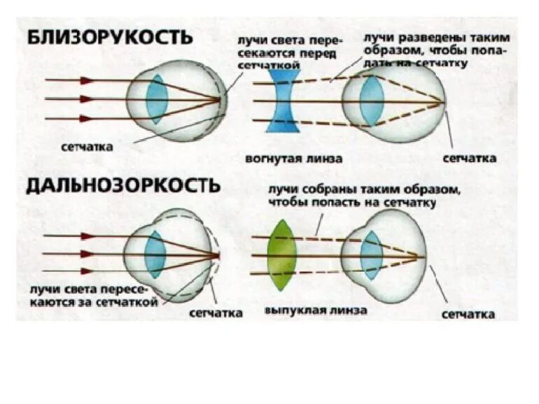 Как можно скорректировать дальнозоркость. Близорукость и дальнозоркость линзы. Строение глаза человека близорукость и дальнозоркость. Дальнозоркость и близорукость строение глаза. Линзы для близорукости и дальнозоркости физика.