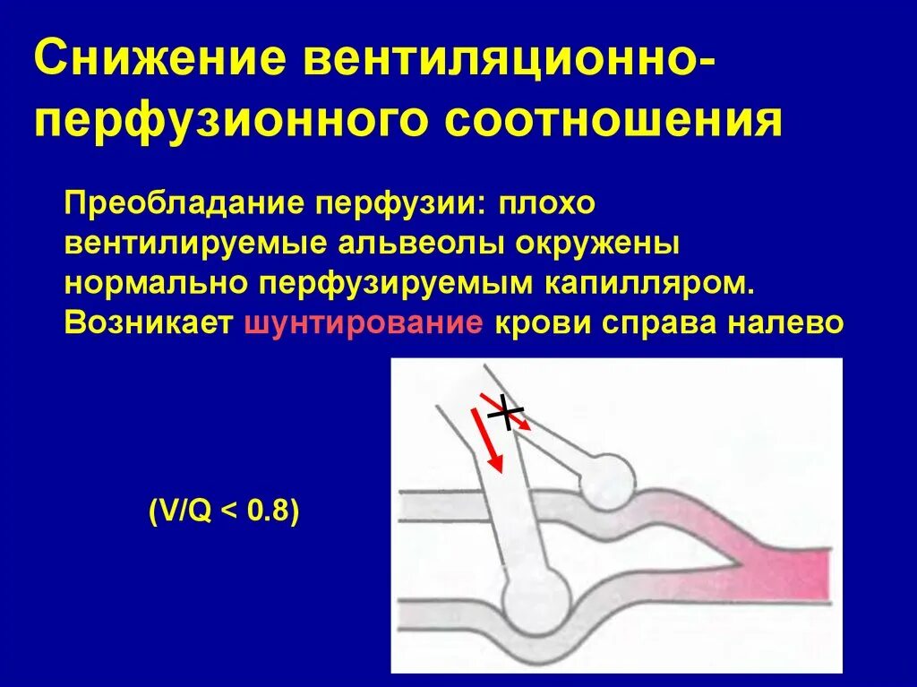 Соотношение вентиляции и перфузии