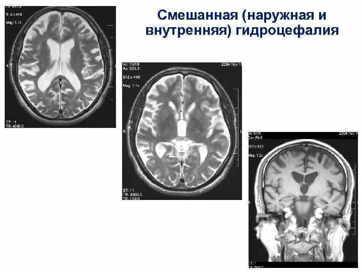 Выражено умеренно гидроцефалия мозга. Наружная гидроцефалия головного мозга. Гидроцефалия головного мозга на кт. Заместительная наружная гидроцефалия кт. Наружная и внутренняя заместительная гидроцефалия на кт.