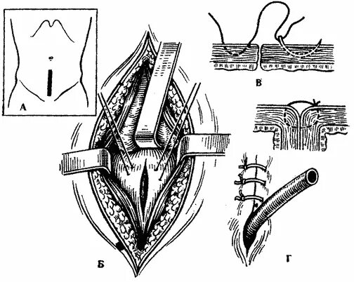 Цистотомия мочевого пузыря. Операция цистостомия мочевого пузыря. Лапаротомия мочевого пузыря. Высокое сечение мочевого пузыря цистотомия. Операция мочевого канала