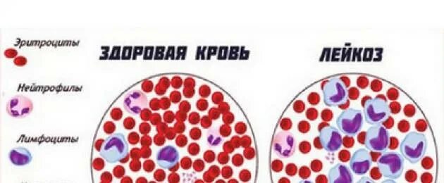 Сколько живут с лейкозом. Лейкоз проявления на коже. Профилактика лейкоза.