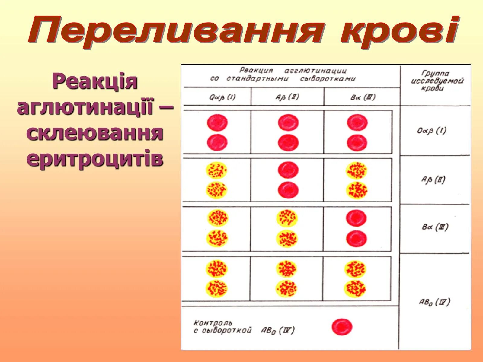 Подгруппы группы крови. Подгруппа 2 группы крови. Подгруппа четвертой группы крови. Какомределить группу крови. Вторая группа крови задача