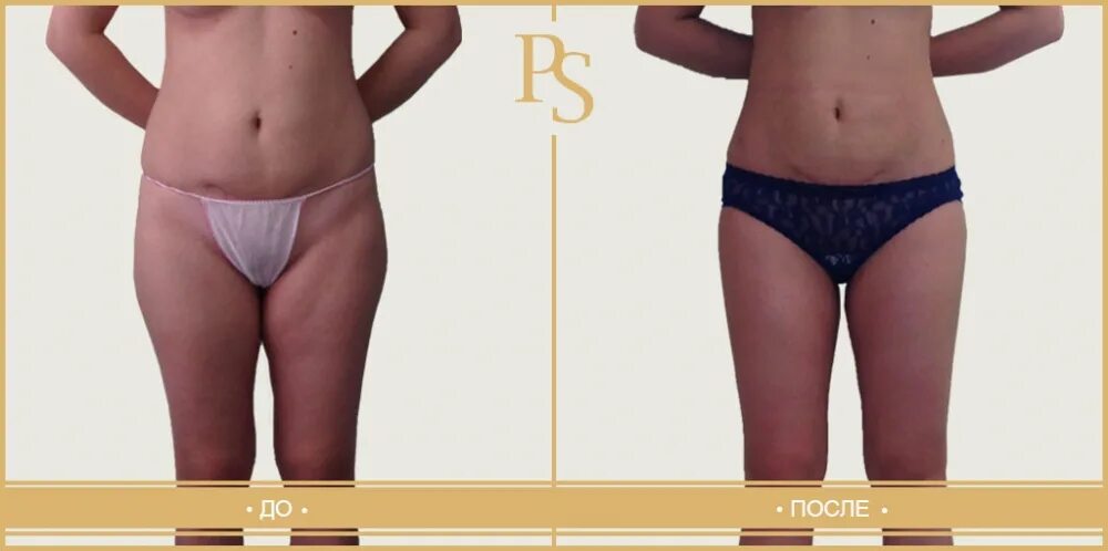 липосакция бедер ваш бренд тут