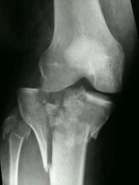 Импрессионный перелом мыщелка. Переломы мыщелков рентген. Перелом мыщелков большеберцовой кости рентген. Импрессионный перелом большеберцовой кости коленного сустава.