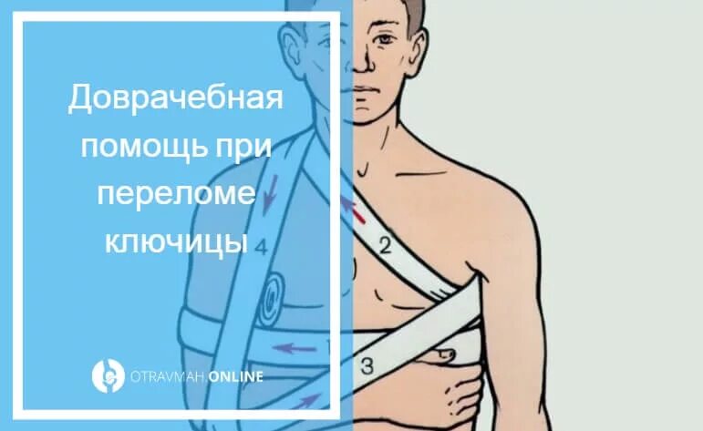 Как оказать помощь при переломе ключицы. Оказание первой помощи при переломе ключицы. оказание первой медицинской помощи при переломе ключицы. иммобилизация при переломе ключицы.