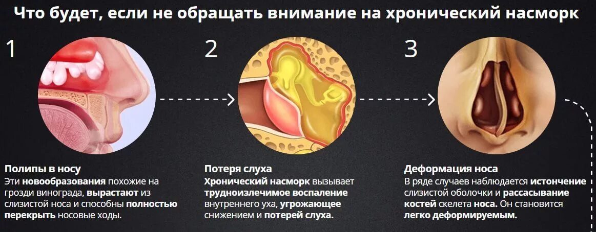 Почему постоянно выделяется. Носовые раковины при аллергическом рините. Хронический насморк причины.