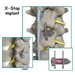 X stop