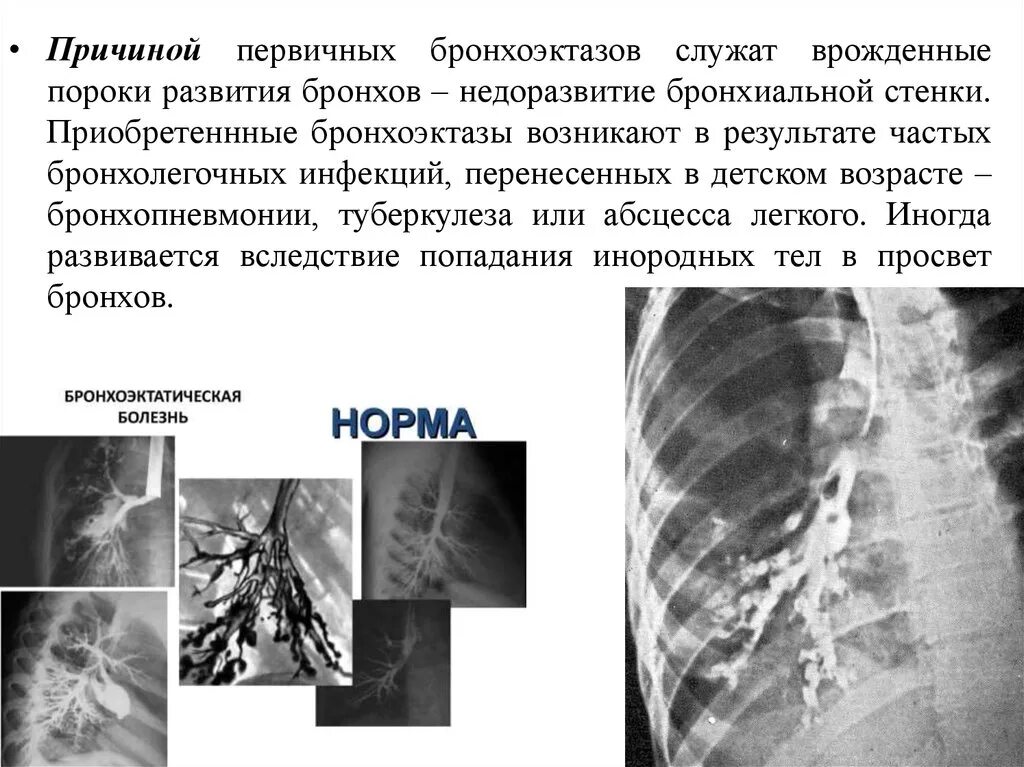 Бронхит бронхоэктатическая болезнь. Бронхография бронхоэктазы. ФБС бронхоэктатическая болезнь. Рентгенограмма при бронхоэктатической болезни. Бронхоэктазы при бронхографии.