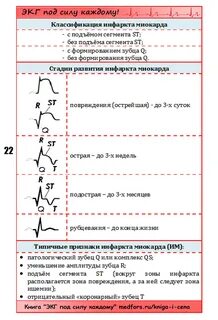 Шпаргалка по экг