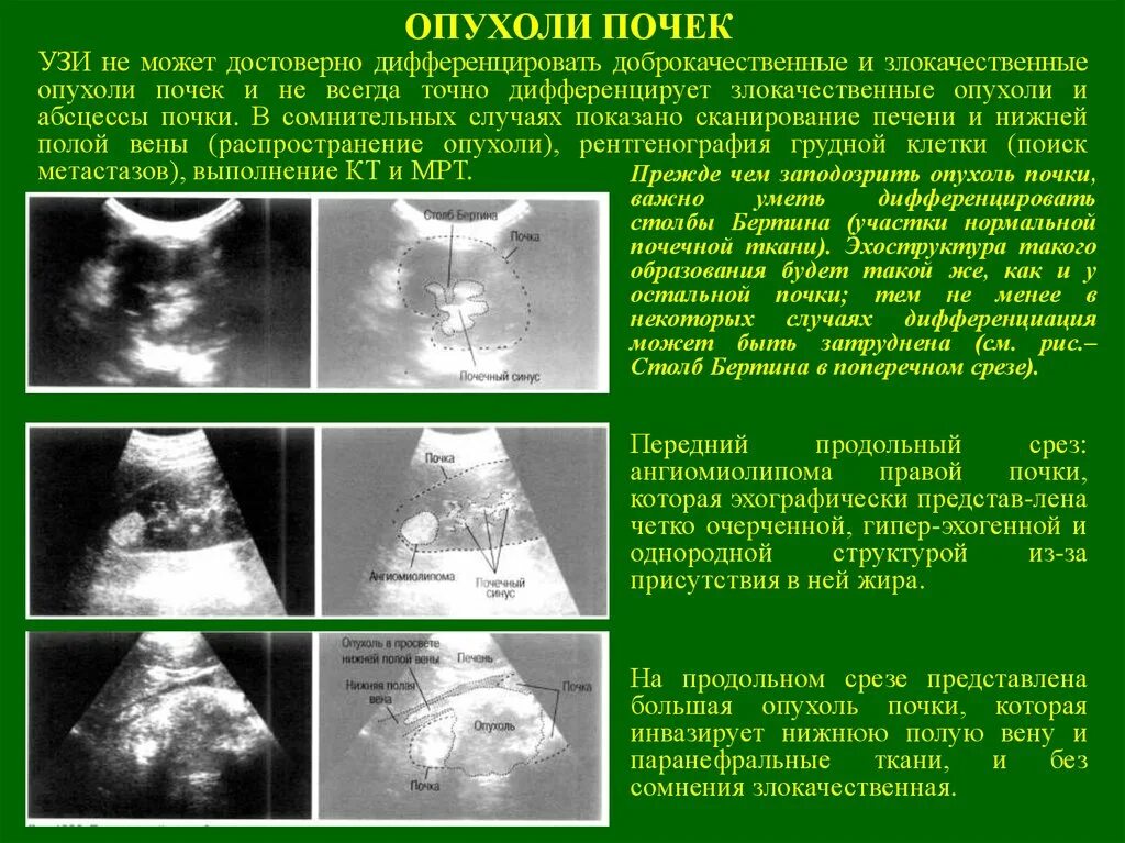 Как отличить на узи. Опухоль почки почки УЗИ. Ультразвуковые симптомы опухоли почки. Объемное образование в почке на УЗИ что это.