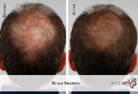 Thinning Hair Solution - MicroArt Semi Permanent Makeup Scalp Shading.