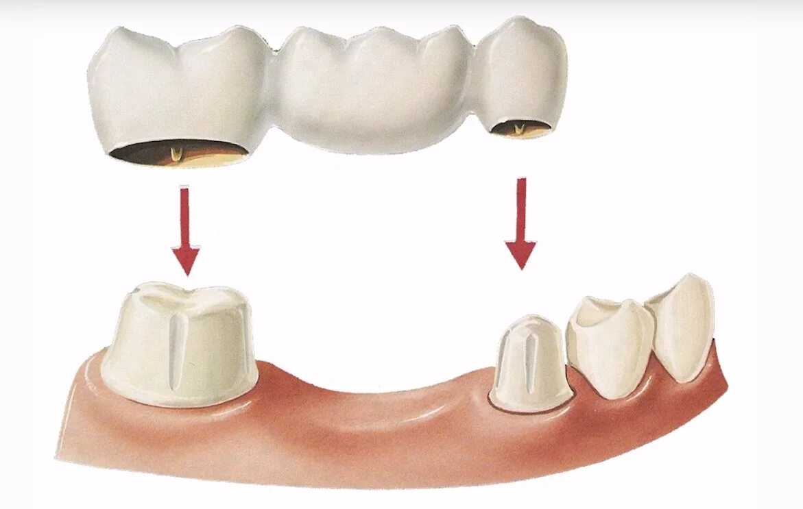 Зубной мост мостовидный протез несъемный. Коронка и мостовидный протез. Мостовидный протез конструкционные элементы. Несъёмный мостовидный протез челюсти. Как называется протезист