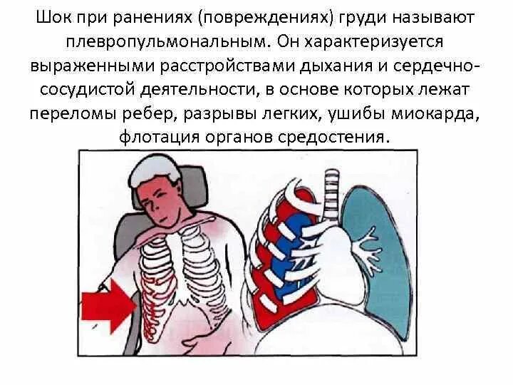 Шок при множественных переломах. Плевропульмонального шока. Множественные переломы ребер. Осложнения перелома ребер повреждение легкого.