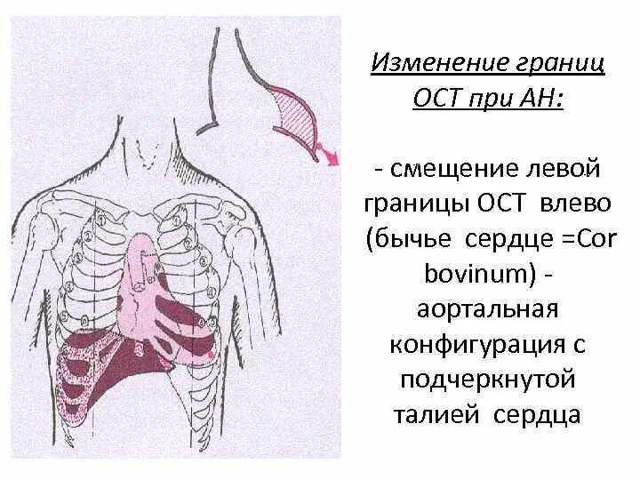 Cor Bovinum конфигурация сердца. Бычье сердце конфигурация сердца. Границы сердца при аортальной конфигурации. Границы сердца при аортальных пороках. Границы расширены влево