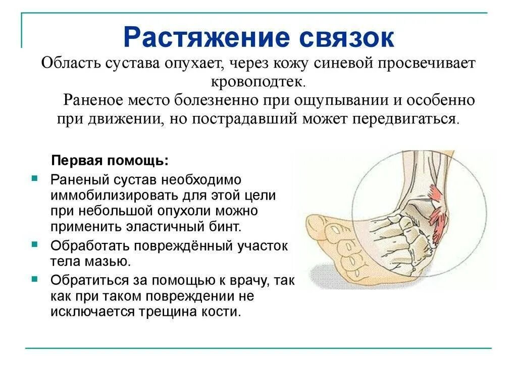 Разрыв и растяжение. Растяжения, повреждения связок.. Характеристика/признаки растяжения связок. Растяжение и разрыв связок. Голеностопный сустав.