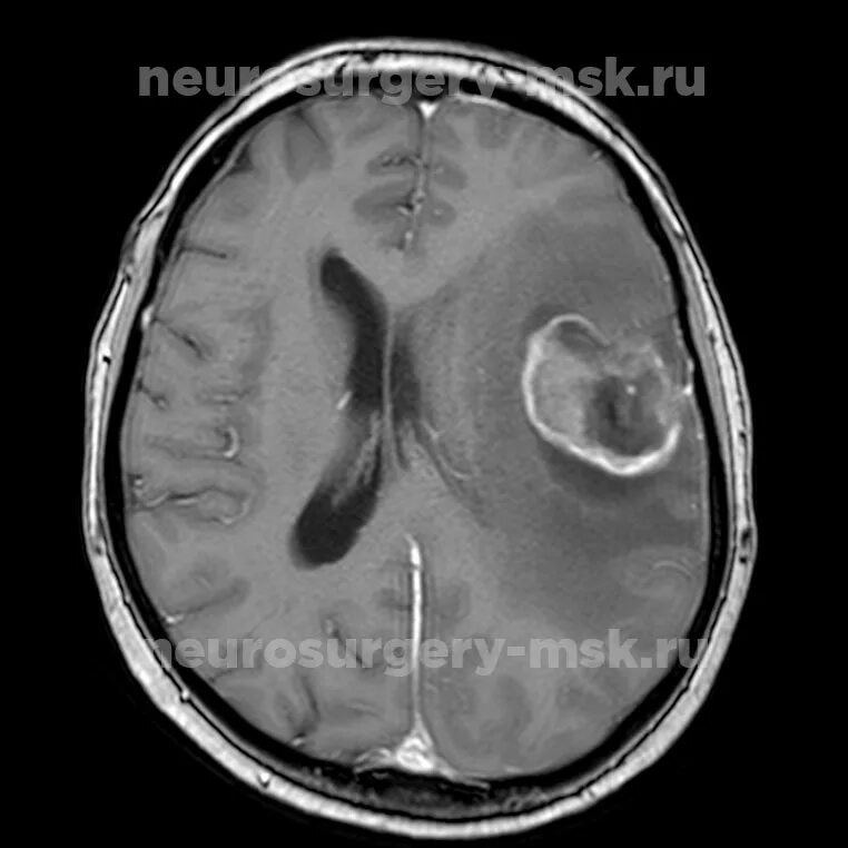 Глиома степени. Глиома мозгового ствола. Злокачественная глиома.