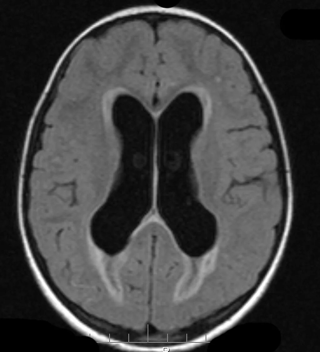Последствия гидроцефалии головного мозга. Дизрезорбтивная гидроцефалия. Наружная гидроцефалия на кт. Обструктивная (несообщающаяся) гидроцефалия,.