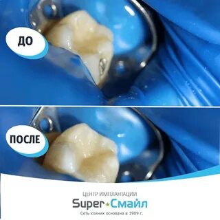 Кариес кальций
