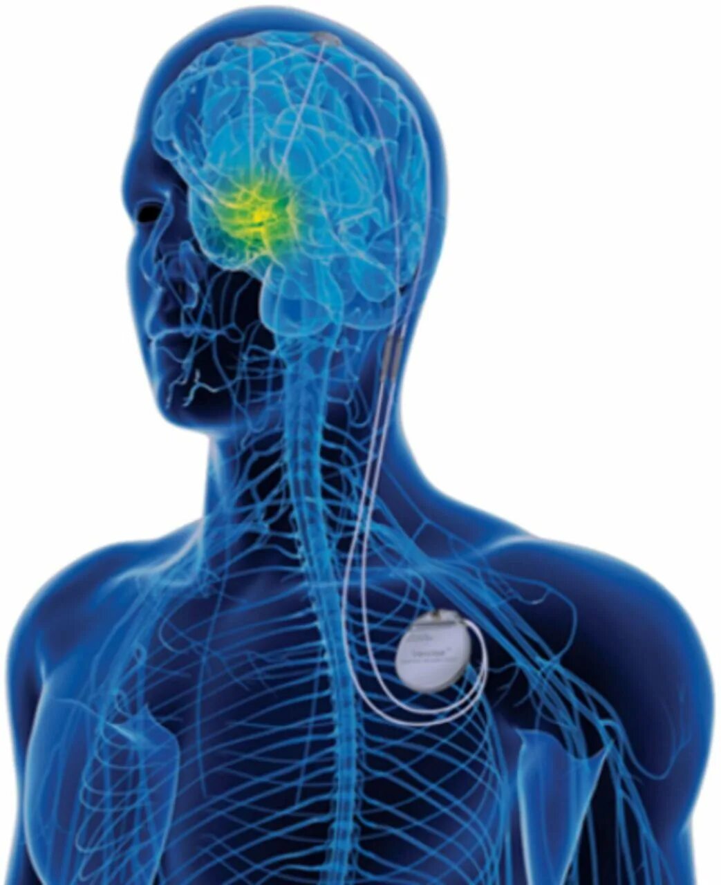 Deep brain. Deep Brain stimulation. Неврология. Нейронные имплантаты. Parkinson DBS.