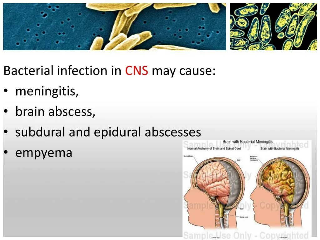 Causing infection. Fungal infections central nervous system.
