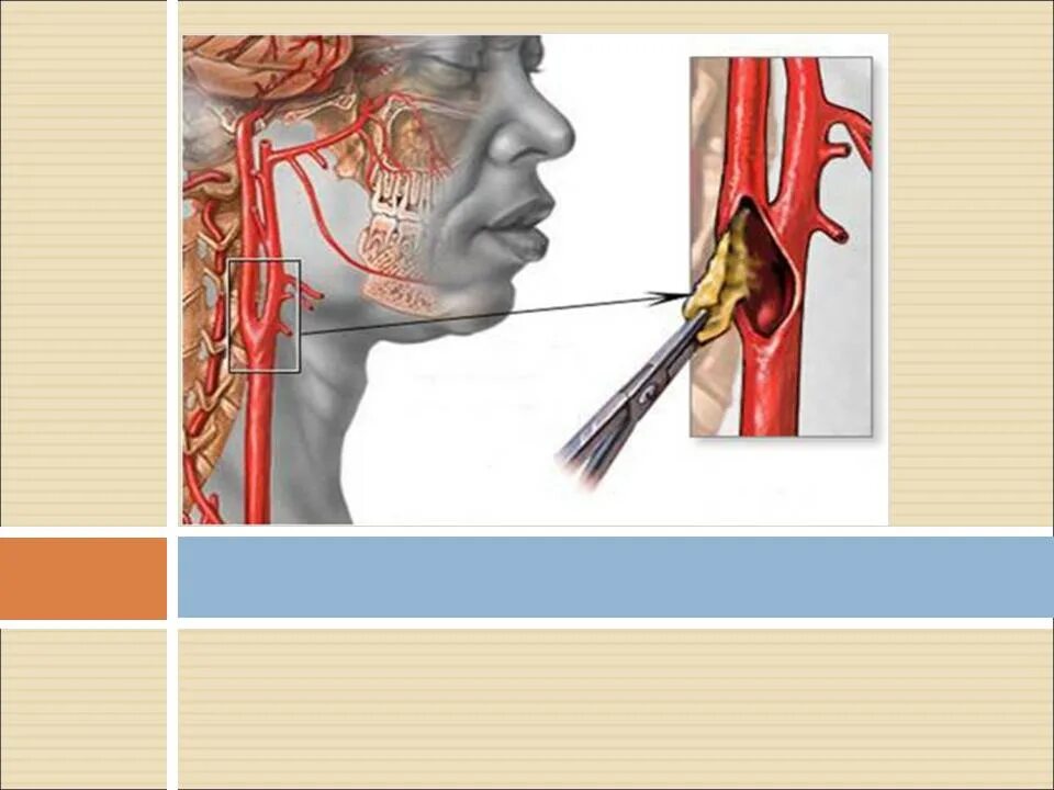 Холестериновая бляшка в сонной артерии. Атеросклеротическая бляшка в сонной артерии. Атеросклероз сосудов сонных артерий. Бляшка сонной ар терииэ. Бляшка на шее операция