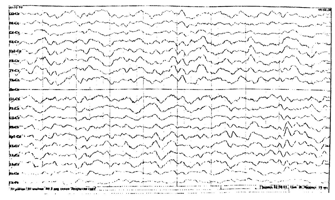 Дельта замедление на ЭЭГ. Дельта кома на ЭЭГ. ЭЭГ при коматозном состоянии. Бета кома на ЭЭГ.