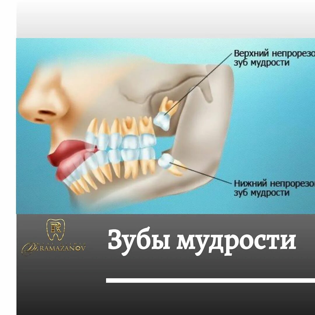 Во сколько вылезают зубы мудрости. Где растет зуб мудрости. строение зубов мудрости.