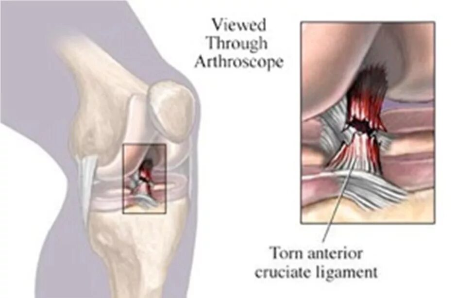 Травма связок сустава. Разрыв связок ПКС коленного сустава. Разрыв крестообразной связки сустава колена. Разрыв ПКС операции реабилитации. Отрыв передней крестообразной связки.