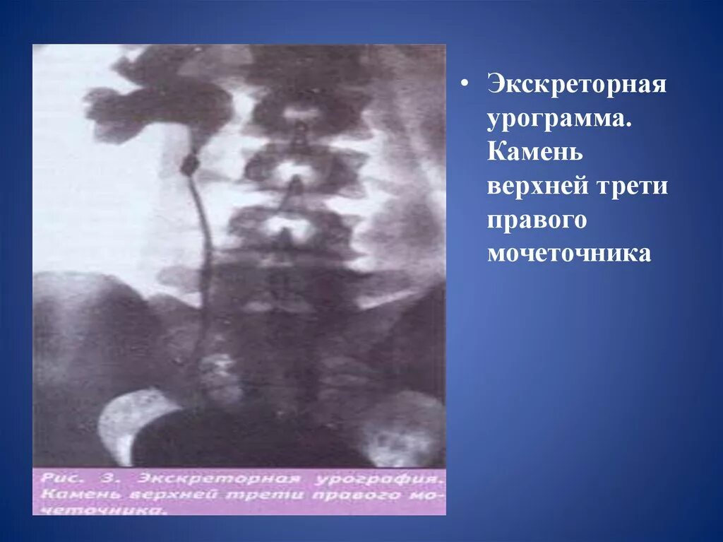 Камни в нижнем мочеточнике. Камень средней трети мочеточника. Камень в верхней трети мочеточника. Конкремент нижней трети мочеточника. Камень в нижней трети мочеточника.