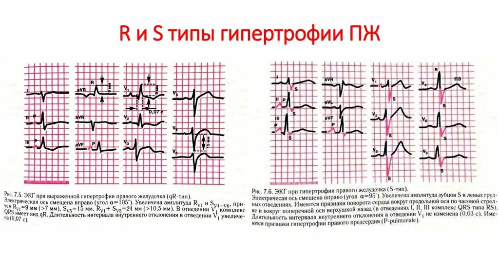 Типы гипертрофии правого желудочка на ЭКГ. S Тип гипертрофии правого желудочка. S Тип гипертрофии правого желудочка на ЭКГ. Гипертрофия правого желудочка s типа на ЭКГ признаки. Сердце против часовой стрелки