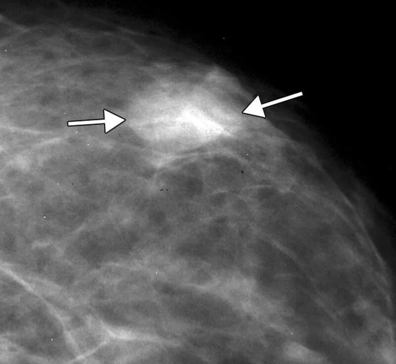 Диффузно фиброзная мастопатия bi rads 2. Фиброаденома молочной железы маммограмма. Фиброаденома молочной железы маммография. Обызвествленная фиброаденома маммография. Фиброаденома молочной железы рентген.