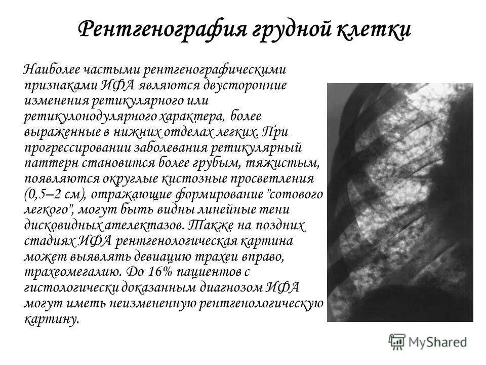 Ретикулярные изменения в легких при. Ретикулярные изменения в легких при. Ретикулярный фиброз на кт. Пневмофиброз на кт. Ретикулярные изменения в легких.