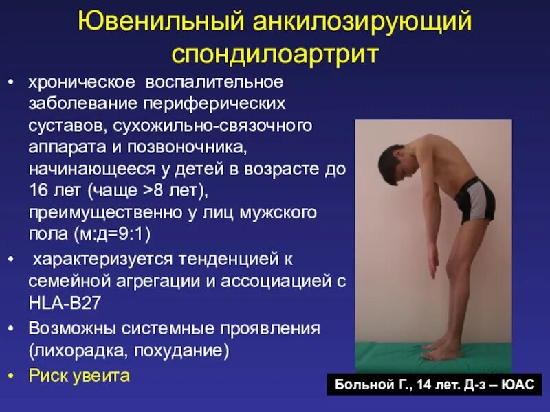 Болезнь бехтерева анкилозирующий. Анкилозирующий спондилоартрит болезнь бехтерева. анкилозирующий спондилит болезнь бехтерева. болезнь бехтерева дебют. спондилоартрит анкилозирующий или болезнь бехтерева.