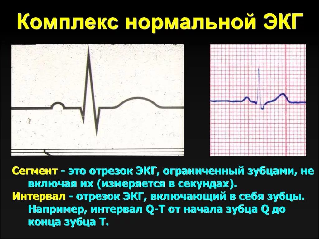 ЭКГ зубцы интервалы комплексы сегменты. Нормальный комплекс ЭКГ анатомия. Комплекс QRS на ЭКГ норма. Интервалы и сегменты ЭКГ В норме. Тяжелое экг