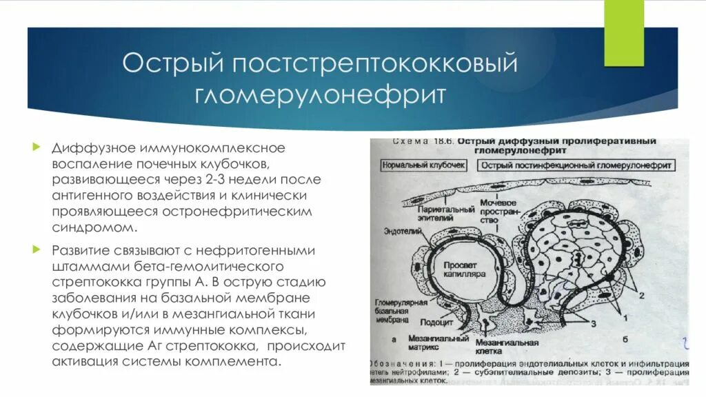 Постстрептококковый гломерулонефрит лечение. Постстрептококковый гломерулонефрит. острый постстрептококковый гломерулонефрит. остpый постстpептококковый (пpолифеpативный) гломеpулонефpит. осложнения острого постстрептококкового гломерулонефрита.
