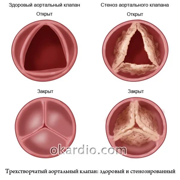 Клапанный стеноз аортального клапана. Кальциноз аортальный клапан сердца. Стеноз аортального клапана клапан. Стеноз митрального и аортального клапана.