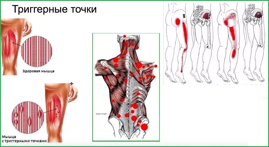 Триггерные точки это простыми словами. Миофасциальный синдром триггерные точки. Миофасциальный болевой синдром триггерные точки. Миофасциальный синдром мышц. Миофасциальный синдром триггерные точки спины.