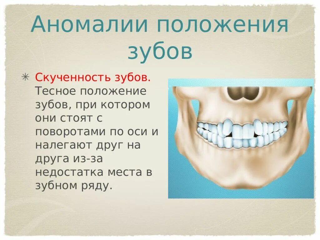 Почему зубы отличаются между собой у разных. Скученность зубов верхней челюсти. Аномалии положения зубов. Аномальное расположение зубов. Скученное расположение зубов.