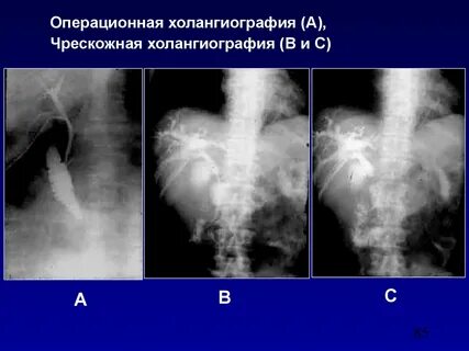 Холангиография