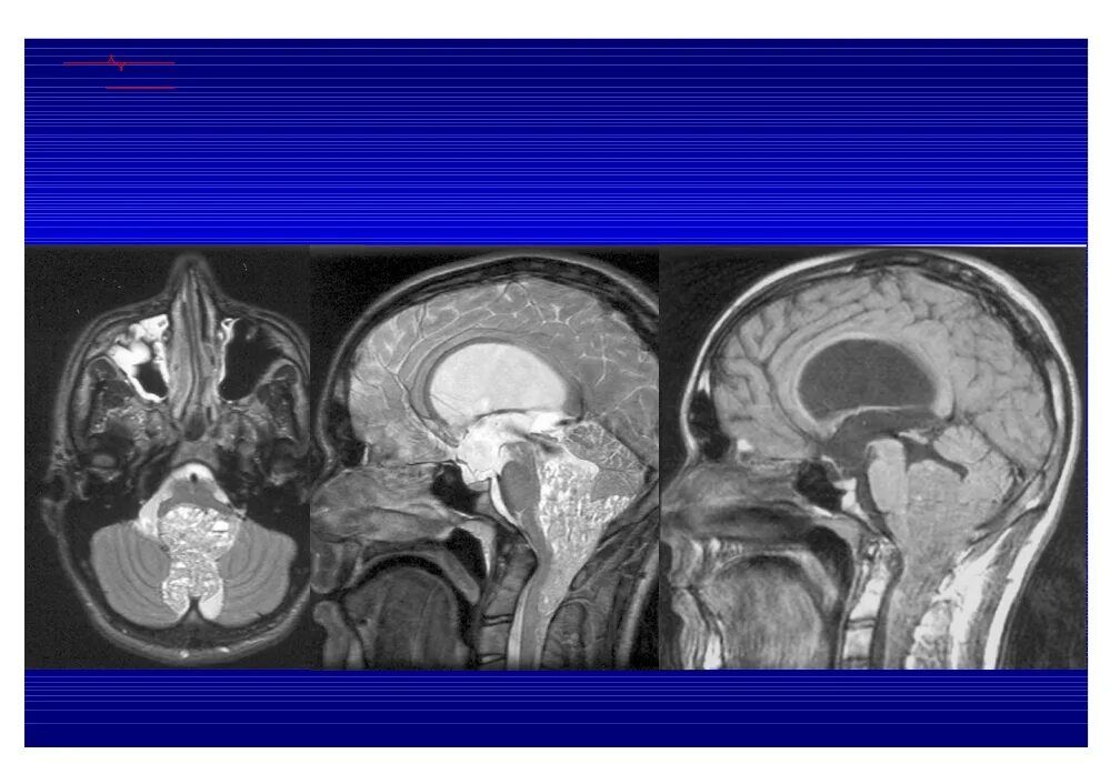 Опухоли желудочков. Эпендимома мозжечка мрт. Эпендимома бокового желудочка. Анапластическая эпендимома IV желудочка. Эпендимома головного мозга мрт.