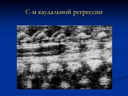 Миграция грыжи