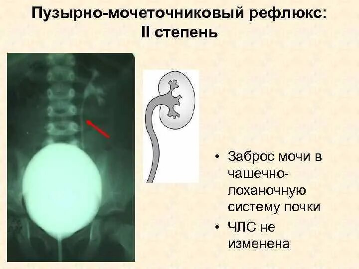 Рефлюкс мочеточника. Пузырно-мочеточникового рефлюкса. Пузырно мочеточниковый рефлюкс цистография. Пузырно-мочеточниковый рефлюкс микционная цистография. Пузырно-мочеточниковый рефлюкс почка на УЗИ.